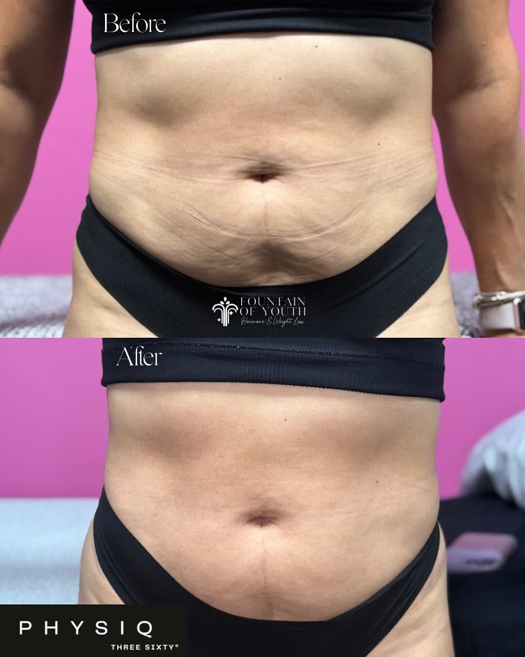 Real PHYSIQ 360 before and after results, front view, from a Fountain of Youth LC patient